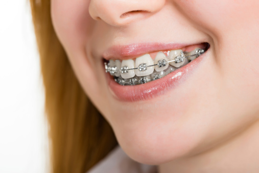 Expert Orthodontist treating a patient with braces in Hendersonville, Goodlettsville, Madison, and Nashville, TN