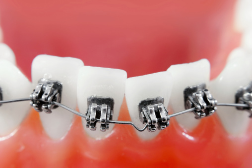 Close-up of an orthodontic model showing brackets and wire on crowded teeth