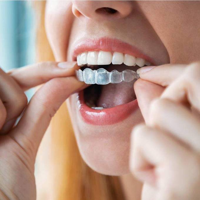 Close-up of a woman inserting a clear Invisalign aligner onto her teeth, showcasing a discreet orthodontic solution.