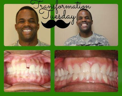 Before and After Braces in Hendersonville, TN