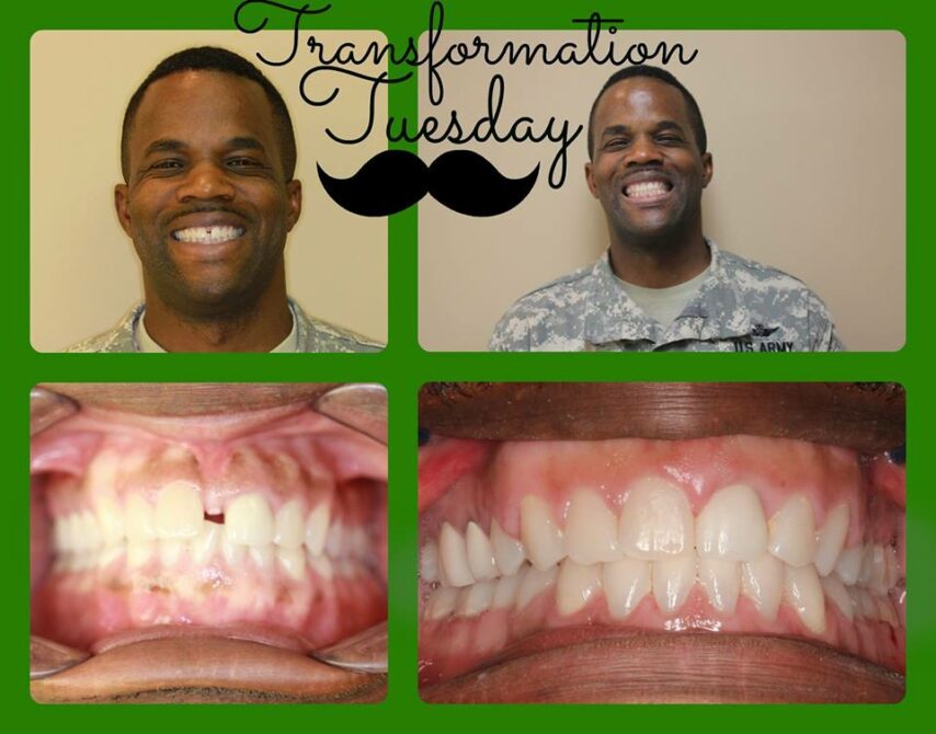 Before-and-after orthodontic case from SmileMaker's patient gallery