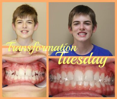 Before and After Braces in Madison, TN