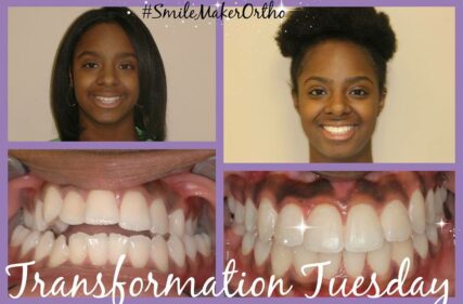 Before and After Braces in Nashville, TN