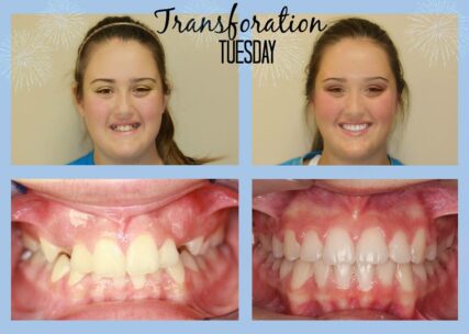 Before and After Braces in Hendersonville, TN