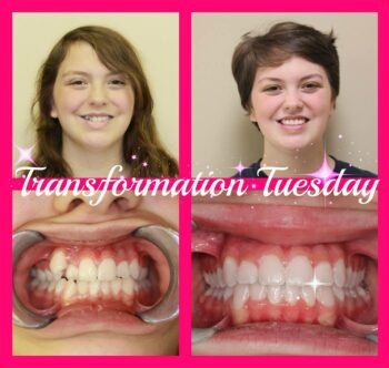 Before and After Braces in Hendersonville, TN