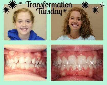 Before and After Braces in Goodlettsville, TN