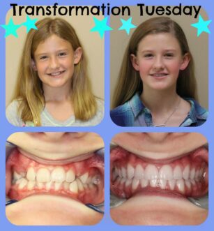 Before and After Braces in Hendersonville, TN