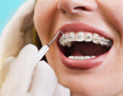 Close-up of teeth with braces being adjusted