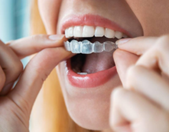 Close-up of a woman inserting a clear Invisalign aligner onto her teeth, showcasing a discreet orthodontic solution.