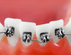 Close-up of an orthodontic model showing brackets and wire on crowded teeth