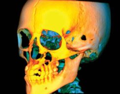 Three-dimensional CBCT rendering of the skull, jaws and teeth